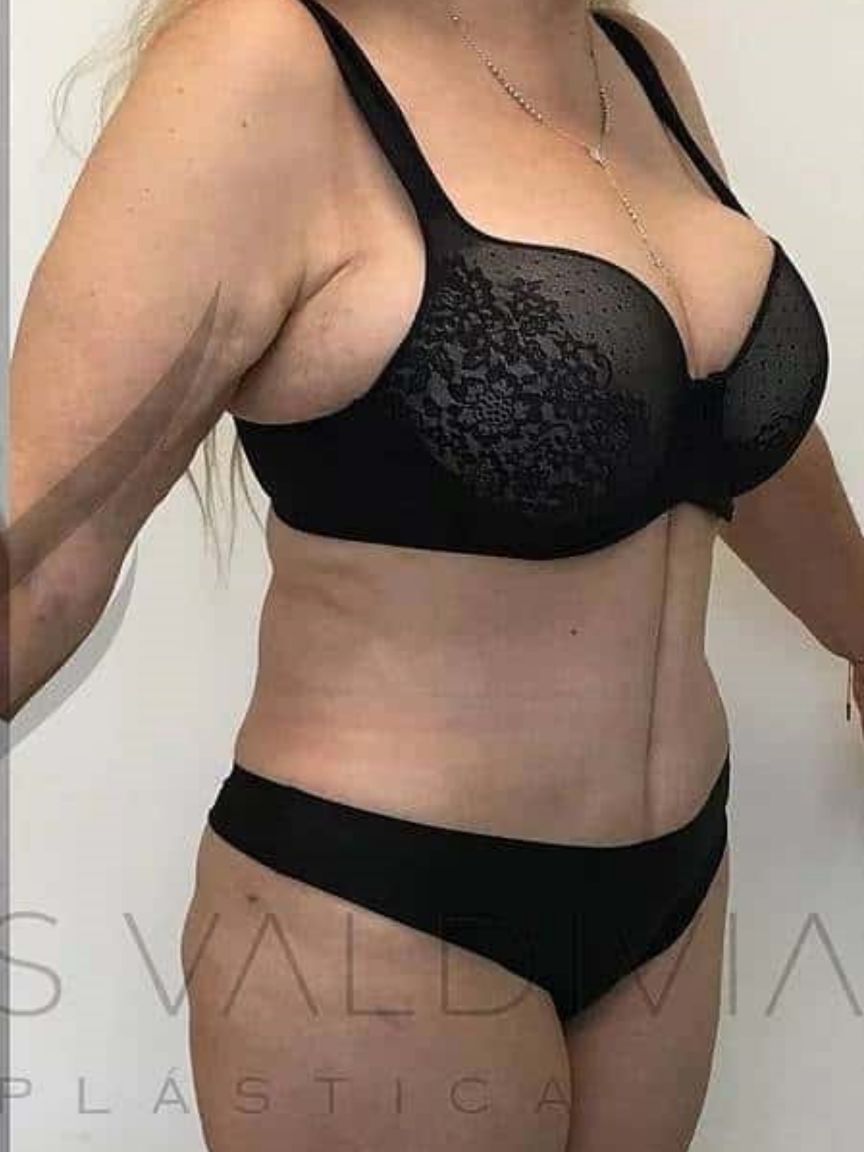 Mommy Makeover