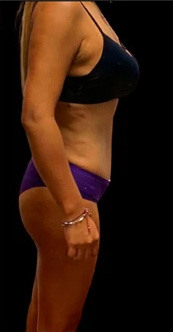 Tummy Tuck