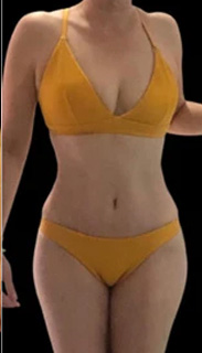 Tummy Tuck