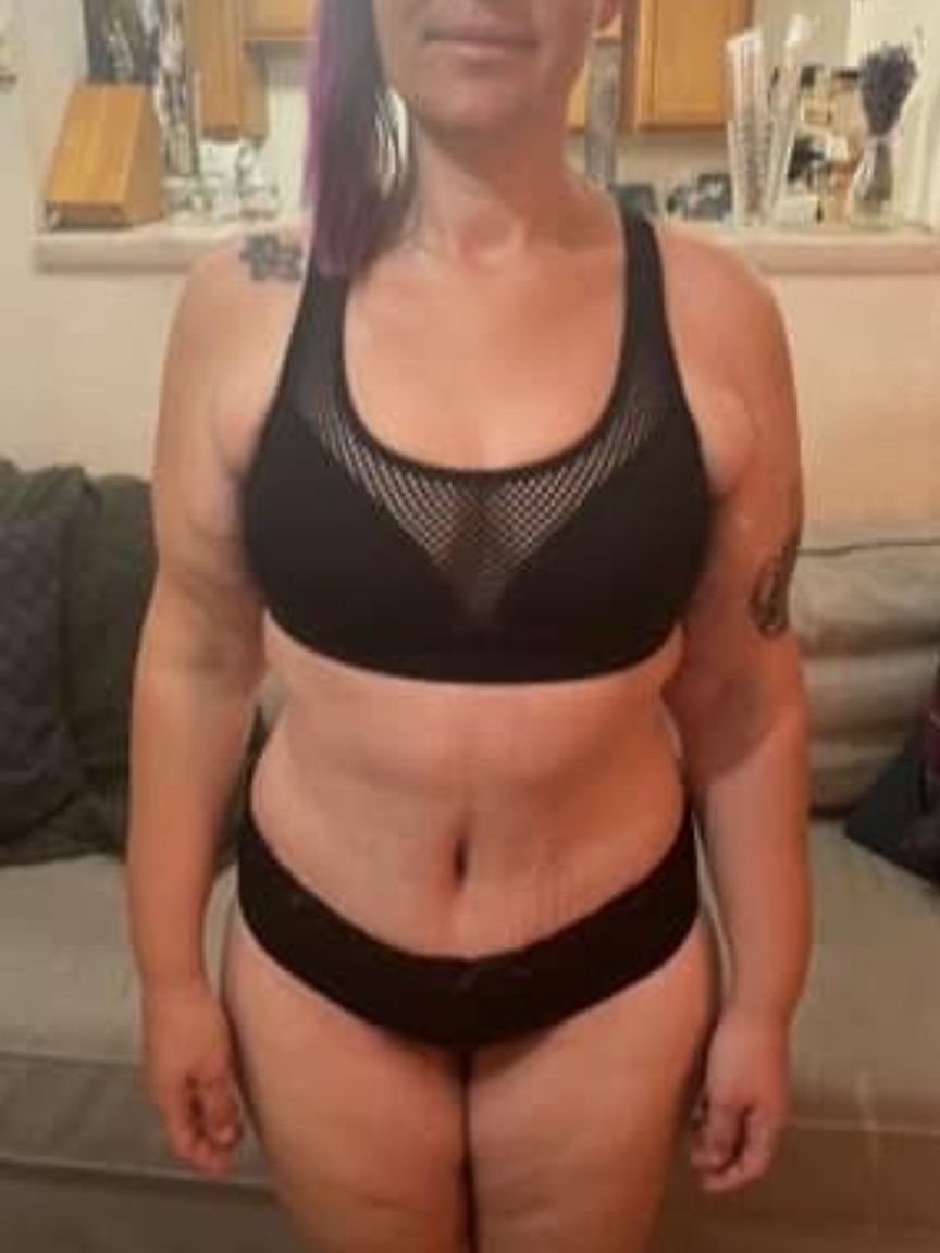 Tummy Tuck