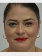 Blepharoplasty