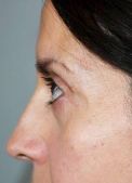 Blepharoplasty