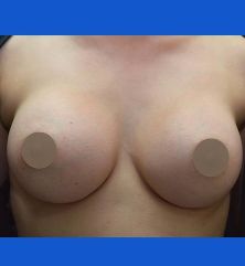 Breast Augmentation