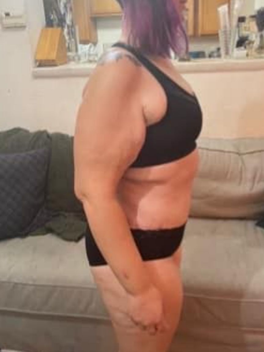 Tummy Tuck