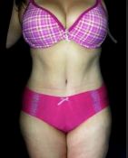Tummy Tuck