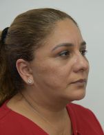 Facelift w/ Blepharoplasty