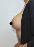 Breast Lift