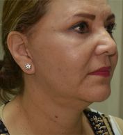 Facelift w/ Blepharoplasty
