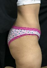 Tummy Tuck