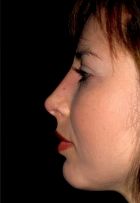Rhinoplasty