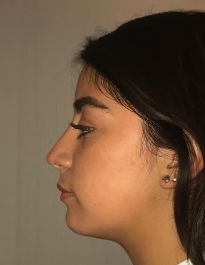 Rhinoplasty