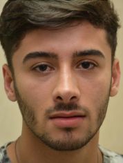 Rhinoplasty