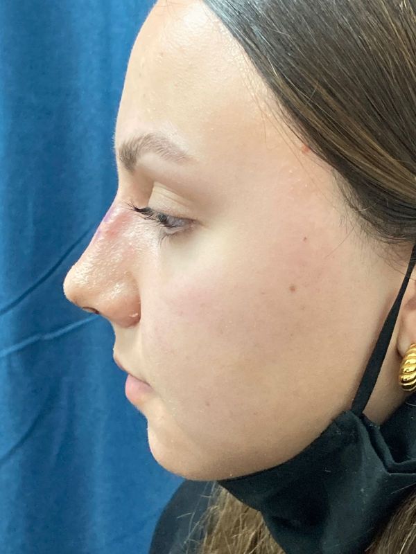 Rhinoplasty