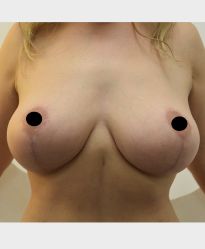 Breast Lift