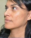 Facelift w/ Blepharoplasty
