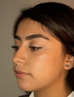 Rhinoplasty