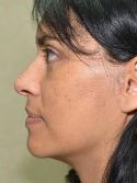 Facelift w/ Blepharoplasty
