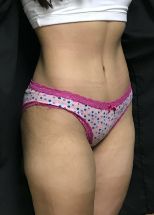 Tummy Tuck