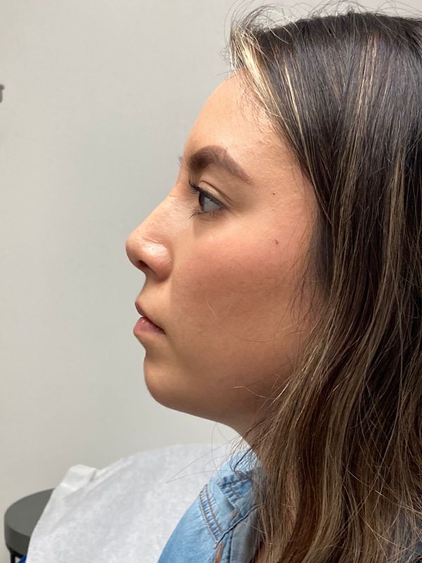Rhinoplasty
