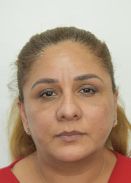 Facelift w/ Blepharoplasty