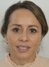 Facelift w/ Blepharoplasty