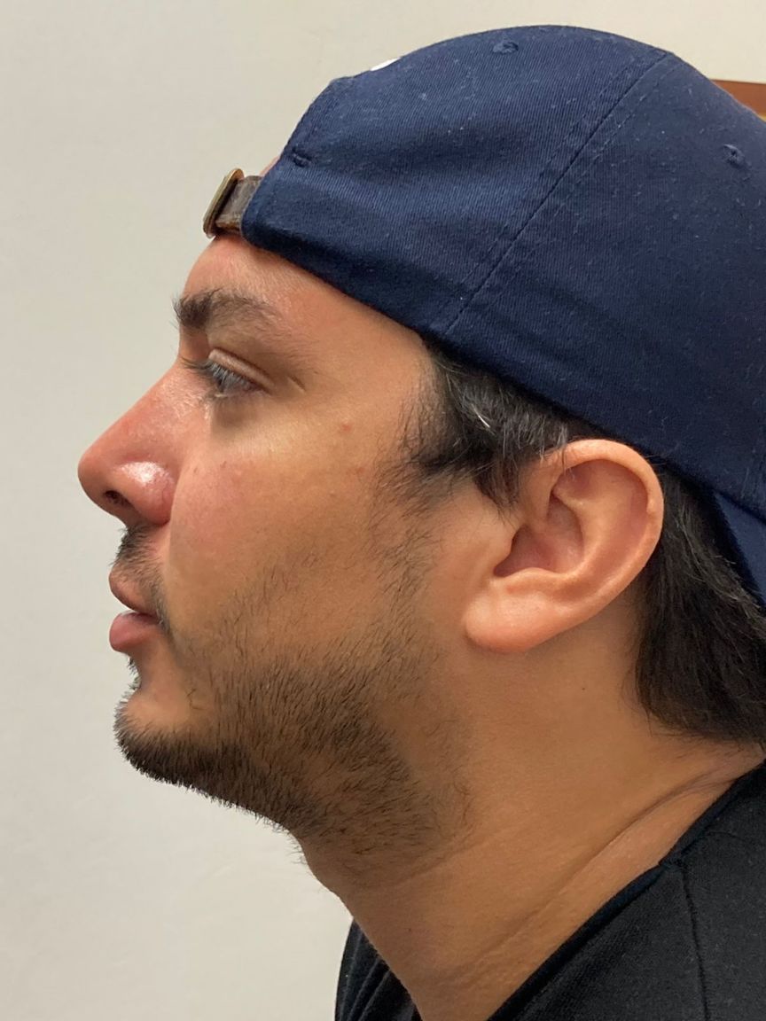 Rhinoplasty