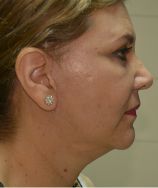 Facelift w/ Blepharoplasty