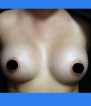 Breast Augmentation