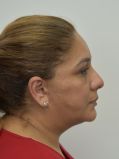 Facelift w/ Blepharoplasty