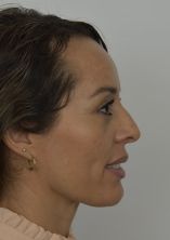 Facelift w/ Blepharoplasty