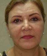 Facelift w/ Blepharoplasty