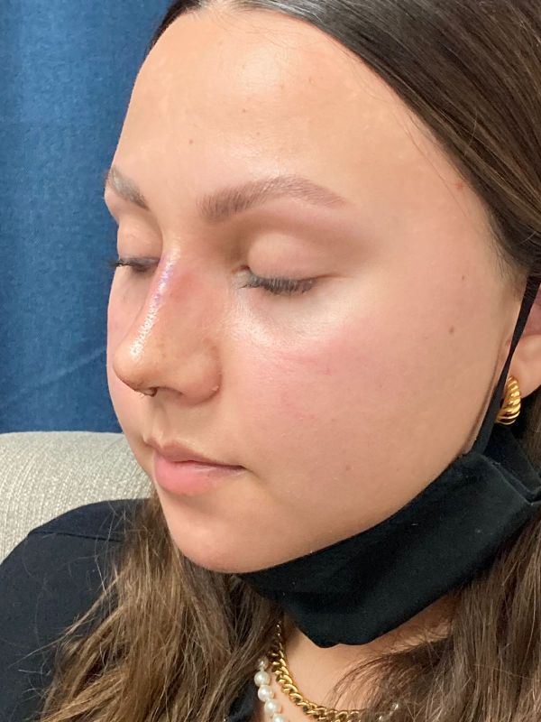 Rhinoplasty