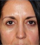 Blepharoplasty