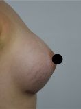 Breast Augmentation