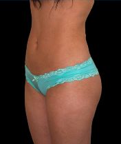 Liposuction w/ BBL