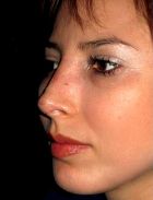 Rhinoplasty