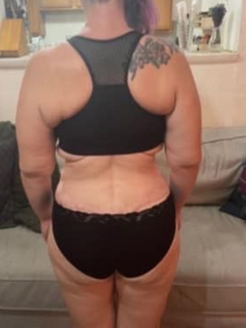 Tummy Tuck