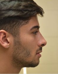 Rhinoplasty