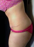 Tummy Tuck