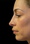 Rhinoplasty