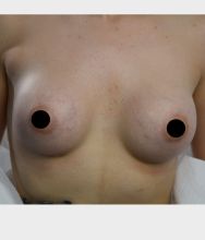Breast Augmentation