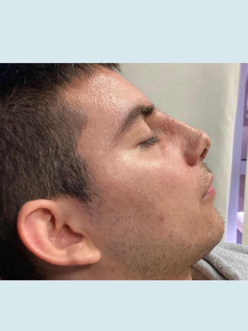 Rhinoplasty