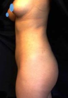 Liposuction w/ BBL
