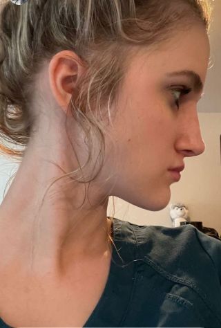 Rhinoplasty