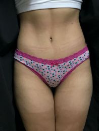 Tummy Tuck
