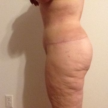 Circular Tummy Tuck w. Lipo