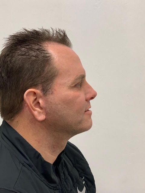Full Facelift w/ Rhinoplasty