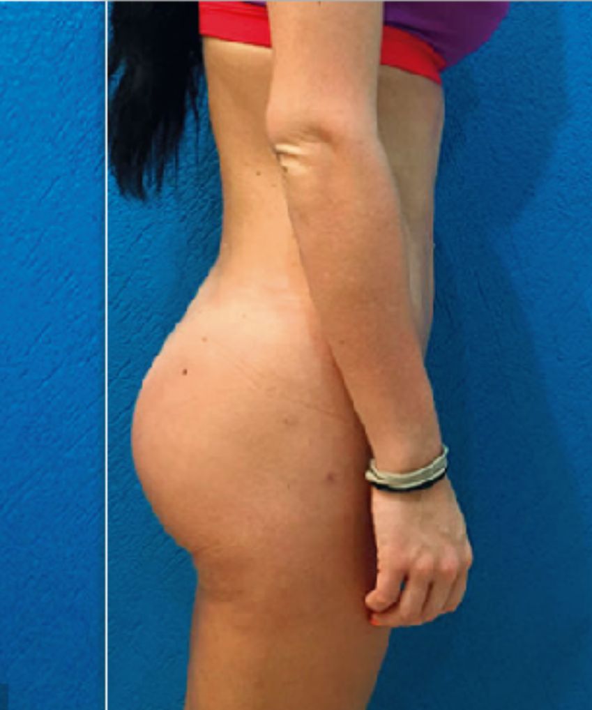 Brazilian Butt Lift