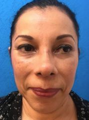 Rhinoplasty