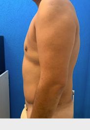Tummy Tuck